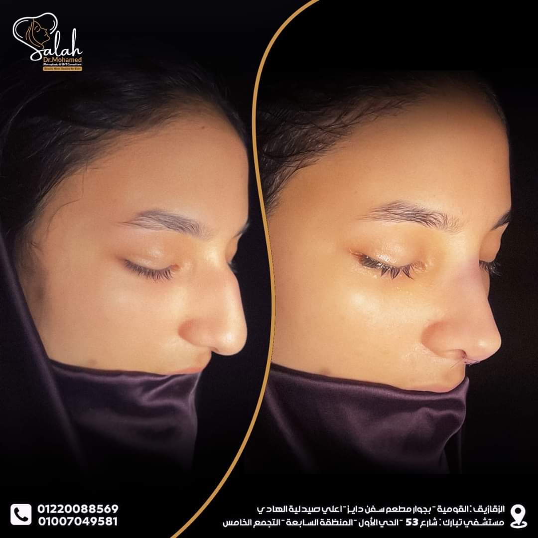 Over-Projected Nose Rhinoplasty